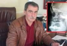 Beynində unudulan güllə ilə 40 il yaşadı